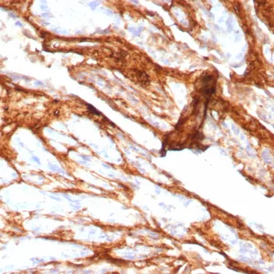 Formalin-fixed, paraffin-embedded human prostate carcinoma stained with Decorin Rabbit Recombinant Monoclonal Antibody (DCN/8760R). HIER: Tris/EDTA, pH9.0, 45min. 2°C: HRP-polymer, 30min. DAB, 5min.