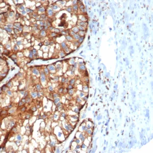 Formalin-fixed, paraffin-embedded human kidney cancer stained with  CD26 Mouse Monoclonal Antibody (DPP4/7415). HIER: Tris/EDTA, pH9.0, 45min. 2°C: HRP-polymer, 30min. DAB, 5min.