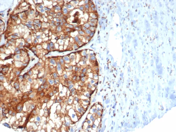 Formalin-fixed, paraffin-embedded human kidney cancer stained with  CD26 Mouse Monoclonal Antibody (DPP4/7415). HIER: Tris/EDTA, pH9.0, 45min. 2°C: HRP-polymer, 30min. DAB, 5min.