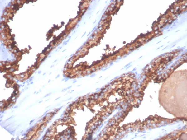Formalin-fixed, paraffin-embedded human prostate cancer stained with  CD26 Mouse Monoclonal Antibody (DPP4/7415). HIER: Tris/EDTA, pH9.0, 45min. 2°C: HRP-polymer, 30min. DAB, 5min.
