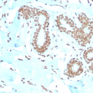 Formalin-fixed, paraffin-embedded human breast carcinoma stained with  E2F4 Mouse Monoclonal Antibody (E2F4/4224). HIER: Tris/EDTA, pH9.0, 45min. 2°C: HRP-polymer, 30min. DAB, 5min.