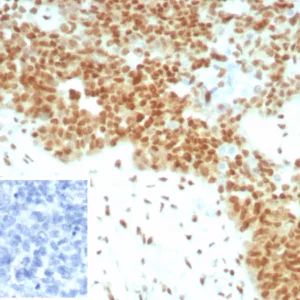 Formalin-fixed, paraffin-embedded human ovarian cancer stained with  E2F4 Recombinant Rabbit Monoclonal Antibody (E2F4/8931R). HIER: Tris/EDTA, pH9.0, 45min. 2°C: HRP-polymer, 30min. DAB, 5min.