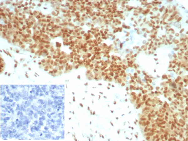 Formalin-fixed, paraffin-embedded human ovarian cancer stained with  E2F4 Recombinant Rabbit Monoclonal Antibody (E2F4/8931R). HIER: Tris/EDTA, pH9.0, 45min. 2°C: HRP-polymer, 30min. DAB, 5min.