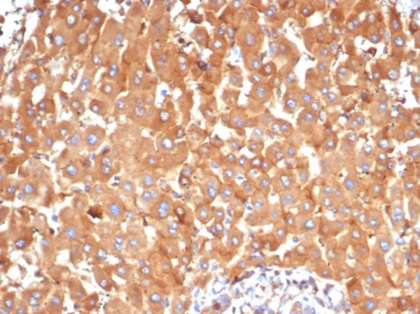 Formalin-fixed, paraffin-embedded human hepatocellular carcinoma stained with Alpha-2-Macroglobulin Mouse Monoclonal Antibody (A2M/6554). HIER: Tris/EDTA, pH9.0, 45min. 2: HRP-polymer, 30min. DAB, 5min.