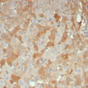 Formalin-fixed, paraffin-embedded human hepatocellular carcinoma stained with Alpha-2-Macroglobulin Mouse Monoclonal Antibody (A2M/6556). HIER: Tris/EDTA, pH9.0, 45min. 2: HRP-polymer, 30min. DAB, 5min.