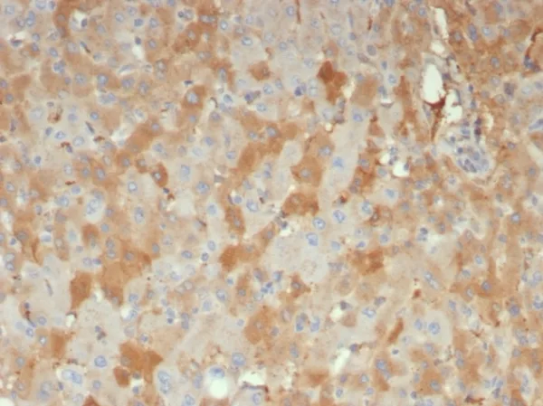 Formalin-fixed, paraffin-embedded human hepatocellular carcinoma stained with Alpha-2-Macroglobulin Mouse Monoclonal Antibody (A2M/6556). HIER: Tris/EDTA, pH9.0, 45min. 2: HRP-polymer, 30min. DAB, 5min.
