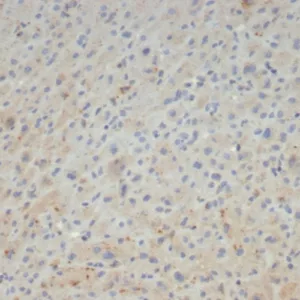 Formalin-fixed, paraffin-embedded human hepatocellular carcinoma stained with Alpha-2-Macroglobulin Mouse Monoclonal Antibody (A2M/4847). HIER: Tris/EDTA, pH9.0, 45min. 2: HRP-polymer, 30min. DAB, 5min.