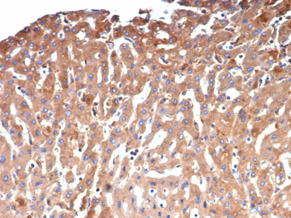 Formalin-fixed, paraffin-embedded human hepatocellular carcinoma stained with Alpha-2-Macroglobulin Mouse Monoclonal Antibody (A2M/4848). HIER: Tris/EDTA, pH9.0, 45min. 2: HRP-polymer, 30min. DAB, 5min.