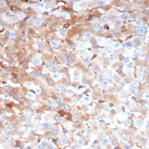Formalin-fixed, paraffin-embedded human hepatocellular carcinoma stained with Alpha-2-Macroglobulin Mouse Monoclonal Antibody (A2M/4849). HIER: Tris/EDTA, pH9.0, 45min. 2: HRP-polymer, 30min. DAB, 5min.