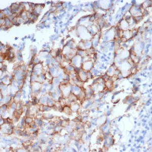 IHC analysis of formalin-fixed, paraffin-embedded human breast carcinoma. Stained using rERBB2/6637 at 2ug/ml in PBS for 30min RT. HIER: Tris/EDTA, pH9.0, 45min. 2°C: HRP-polymer, 30min. DAB, 5min.
