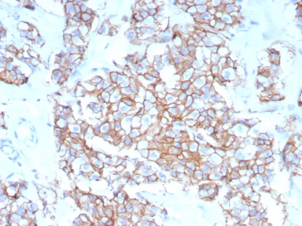 IHC analysis of formalin-fixed, paraffin-embedded human breast carcinoma. Stained using rERBB2/9401 at 2ug/ml in PBS for 30min RT. HIER: Tris/EDTA, pH9.0, 45min. 2°C: HRP-polymer, 30min. DAB, 5min.