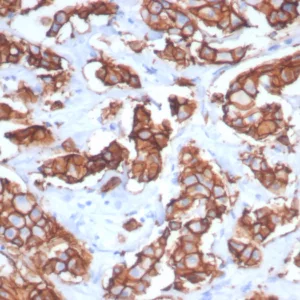 Formalin-fixed, paraffin-embedded human breast carcinoma stained with HER-2 Recombinant Rabbit Monoclonal Antibody (ERBB2/7158R). HIER: Tris/EDTA, pH9.0, 45min. 2°C: HRP-polymer, 30min. DAB, 5min.
