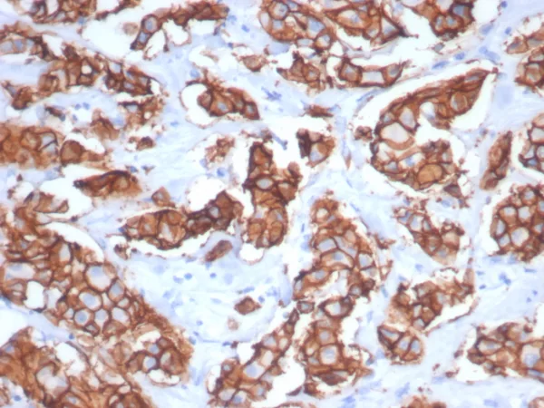 Formalin-fixed, paraffin-embedded human breast carcinoma stained with HER-2 Recombinant Rabbit Monoclonal Antibody (ERBB2/7158R). HIER: Tris/EDTA, pH9.0, 45min. 2°C: HRP-polymer, 30min. DAB, 5min.