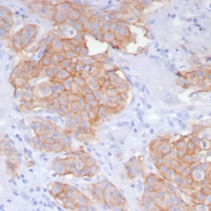 Formalin-fixed, paraffin-embedded human breast carcinoma stained with HER-2 Recombinant Rabbit Monoclonal Antibody (ERBB2/8142R). HIER: Tris/EDTA, pH9.0, 45min. 2: HRP-polymer, 30min. DAB, 5min.