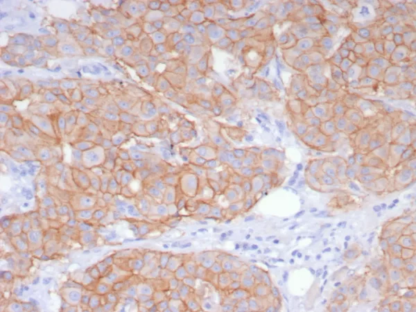 Formalin-fixed, paraffin-embedded human breast carcinoma stained with HER-2 Recombinant Rabbit Monoclonal Antibody (ERBB2/8142R). HIER: Tris/EDTA, pH9.0, 45min. 2: HRP-polymer, 30min. DAB, 5min.