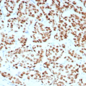 Formalin fixed paraffin embedded human breast carcinoma stained with ER, alpha Recombinant Mouse Monoclonal Antibody (rESR1/8761). HIER: Tris/EDTA, pH9.0, 45min. 2°C: HRP-polymer, 30min. DAB, 5min