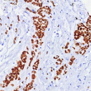 Formalin fixed paraffin embedded human breast carcinoma stained with ER, alpha Rabbit Recombinant Monoclonal Antibody (ESR1/7444R). HIER: Tris/EDTA, pH9.0, 45min. 2: HRP-polymer, 30min. DAB, 5min.