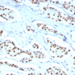 Formalin fixed paraffin embedded human breast carcinoma stained with ER, alpha Rabbit Recombinant Monoclonal Antibody (ESR1/8407R). HIER: Tris/EDTA, pH9.0, 45min. 2: HRP-polymer, 30min. DAB, 5min.