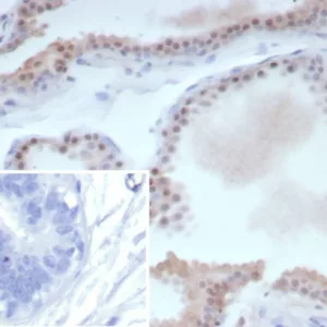Formalin-fixed, paraffin-embedded human breast cancer stained with ER-beta Recombinant Rabbit Monoclonal Antibody (ESR2/9251R). Inset: PBS instead of primary antibody; secondary only negative control.