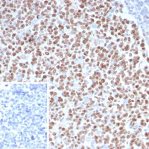 Formalin-fixed, paraffin-embedded human Lynch disease colon stained with EZH2 / KMT6 Mouse Monoclonal Antibody (EZH2/4687). HIER: Tris/EDTA, pH9.0, 45min. 2°C: HRP-polymer, 30min. DAB, 5min.
