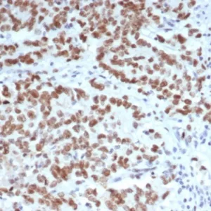 FFPE human Lynch syndrome colon carcinoma stained with EZH2 / KMT6 Mouse Monoclonal Antibody (EZH2/6988). HIER: Tris/EDTA, pH9.0, 45min. 2: HRP-polymer, 30min. DAB, 5min.