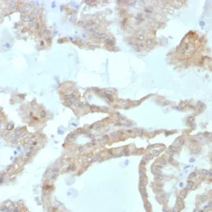 Formalin-fixed, paraffin-embedded human renal cell carcinoma stained with FABP2 Mouse Monoclonal Antibody (FABP2/7669). HIER: Tris/EDTA, pH9.0, 45min. 2: HRP-polymer, 30min. DAB, 5min.