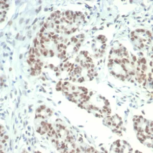 Formalin-fixed, paraffin-embedded human colon carcinoma stained with KDM1A Mouse Monoclonal Antibody (PCRP-KDM1A-1A10). HIER: Tris/EDTA, pH9.0, 45min. 2°C: HRP-polymer, 30min. DAB, 5min.