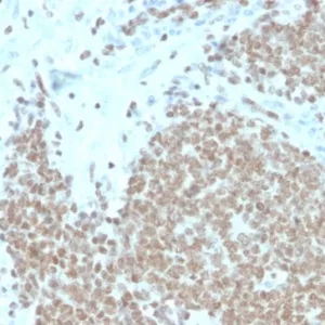 Formalin-fixed, paraffin-embedded human Ewing&apos;s Sarcoma (EWS) stained with Fli1 Recombinant Rabbit Monoclonal Antibody (FLI1/4371R). HIER: Tris/EDTA, pH9.0, 45min. 2°C: HRP-polymer, 30min. DAB, 5min.