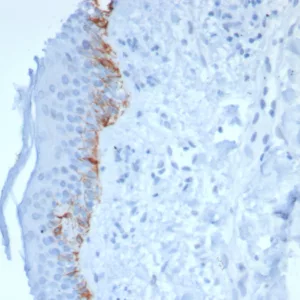 Formalin-fixed, paraffin-embedded human skin stained with  MART-1 Recombinant Mouse Monoclonal Antibody (rMLANA/8180).  HIER: Tris/EDTA, pH9.0, 45min. 2°C: HRP-polymer, 30min. DAB, 5min.