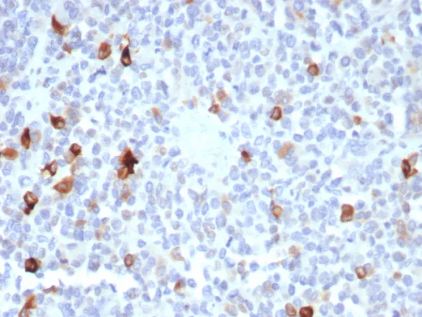 Formalin-fixed, paraffin-embedded human melanoma stained with MART-1 Recombinant Rabbit Monoclonal Antibody (MLANA/8365R). HIER: Tris/EDTA, pH9.0, 45min. 2: HRP-polymer, 30min. DAB, 5min.