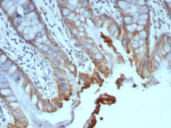 Formalin-fixed, paraffin-embedded human colon carcinoma stained with ICOS-L Mouse Monoclonal Antibody (ICOSL/7700). HIER: Tris/EDTA, pH9.0, 45min. 2°C: HRP-polymer, 30min. DAB, 5min.