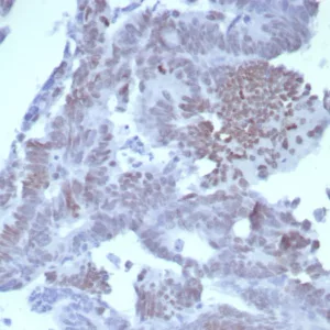 Formalin-fixed, paraffin-embedded human colon carcinoma stained with SATB2 Rabbit Recombinant Monoclonal Antibody (SATB2/8264R). HIER: Tris/EDTA, pH9.0, 45min. 2°C: HRP-polymer, 30min. DAB, 5min.