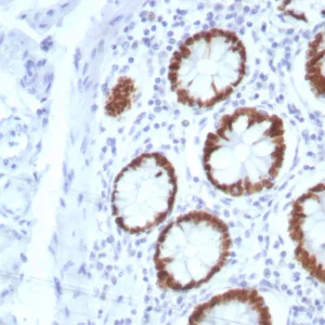 Formalin-fixed, paraffin-embedded human colon stained with SATB2 Rabbit Recombinant Monoclonal Antibody (SATB2/8877R). HIER: Tris/EDTA, pH9.0, 45min. 2°C: HRP-polymer, 30min. DAB, 5min.