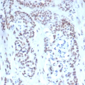 Formalin-fixed, paraffin-embedded human prostate stained with TDP43 Mouse Monoclonal Antibody (TARDP/349). HIER: Tris/EDTA, pH9.0, 45min. 2°C: HRP-polymer, 30min. DAB, 5min.