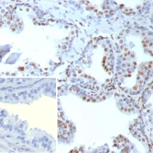 Formalin-fixed, paraffin-embedded human prostate stained with TDP43 Recombinant Rabbit Monoclonal Antibody (TARDP/9299R). Inset: PBS instead of primary antibody; secondary only negative control.