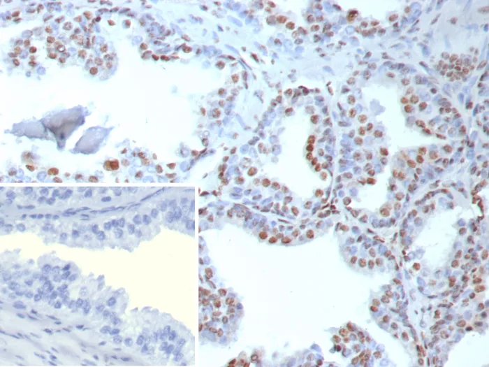 Formalin-fixed, paraffin-embedded human prostate stained with TDP43 Recombinant Rabbit Monoclonal Antibody (TARDP/9299R). Inset: PBS instead of primary antibody; secondary only negative control. TDP43