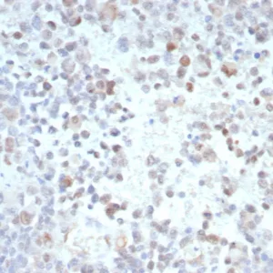 Formalin-fixed, paraffin-embedded human melanoma stained with PRAME Mouse Monoclonal Antibody (PRAME/9189). HIER: Tris/EDTA, pH9.0, 45min. 2°C: HRP-polymer, 30min. DAB, 5min.