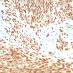 Formalin-fixed, paraffin-embedded human melanoma stained with PRAME Rabbit Monoclonal Antibody (PRAME/8558R). HIER: Tris/EDTA, pH9.0, 45min. 2°C: HRP-polymer, 30min. DAB, 5min.
