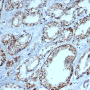Formalin-fixed, paraffin-embedded human prostate carcinoma stained with AMACR Mouse Monoclonal Antibody (AMACR/4757). HIER: Tris/EDTA, pH9.0, 45min. 2°C: HRP-polymer, 30min. DAB, 5min.