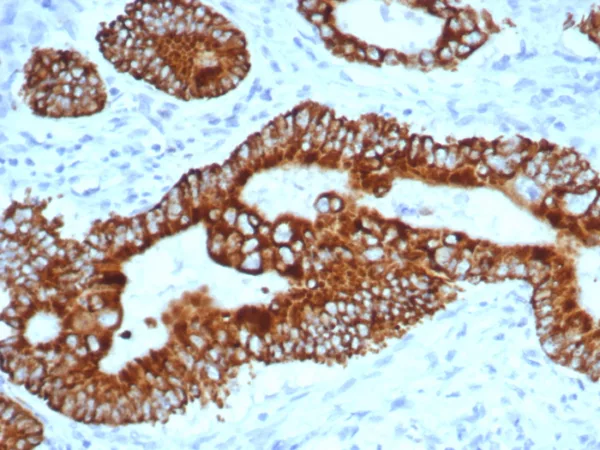 Formalin-fixed, paraffin-embedded human colon carcinoma stained with AMACR Mouse Monoclonal Antibody (AMACR/4757). HIER: Tris/EDTA, pH9.0, 45min. 2°C: HRP-polymer, 30min. DAB, 5min.