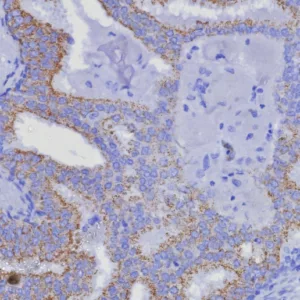 Formalin-fixed, paraffin-embedded human prostate carcinoma stained with  AMACR Recombinant Rabbit Monoclonal Antibody (AMACR/8350R). HIER: Tris/EDTA, pH9.0, 45min. 2: HRP-polymer, 30min. DAB, 5min.