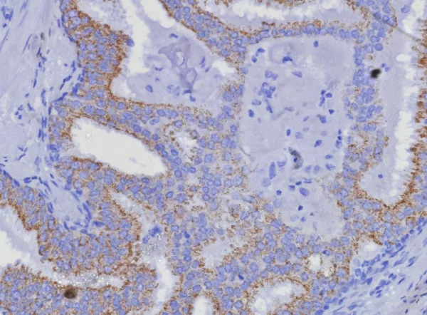 Formalin-fixed, paraffin-embedded human prostate carcinoma stained with  AMACR Recombinant Rabbit Monoclonal Antibody (AMACR/8350R). HIER: Tris/EDTA, pH9.0, 45min. 2: HRP-polymer, 30min. DAB, 5min.