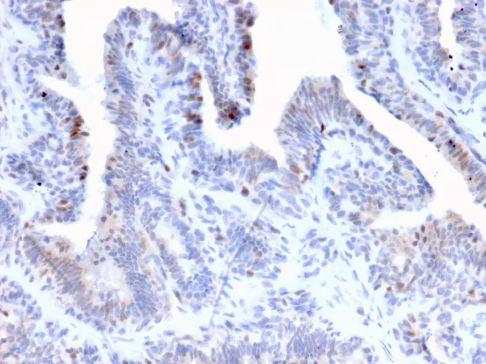 Formalin-fixed, paraffin-embedded human prostate cancer stained with NR5A2 Mouse Monoclonal Antibody (PCRP-NR5A2-1B8). HIER: Tris/EDTA, pH9.0, 45min. 2°C: HRP-polymer, 30min. DAB, 5min. NR5A2 / LRH1 Antibody - Image 3