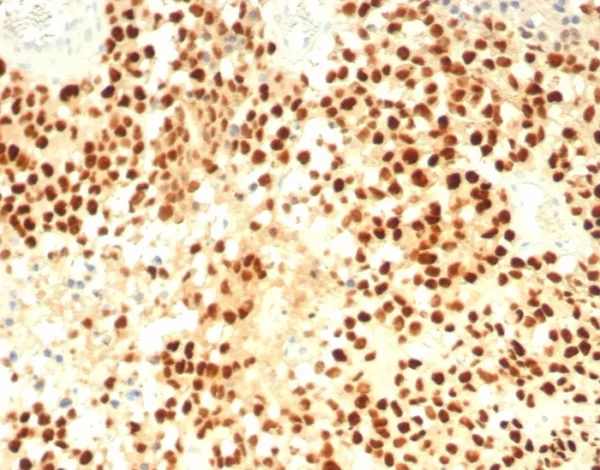 Formalin-fixed, paraffin-embedded human adrenal cortex stained with SF-1 Recombinant Rabbit Monoclonal Antibody (SF1/8000R). HIER: Tris/EDTA, pH9.0, 45min. 2°C: HRP-polymer, 30min. DAB, 5min.