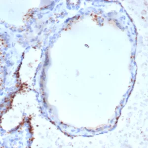 Formalin-fixed, paraffin-embedded human thyroid stained with GAD2 (GAD65) Mouse Monoclonal Antibody (GAD2/6484). HIER: Tris/EDTA, pH9.0, 45min. 2°C: HRP-polymer, 30min. DAB, 5min.