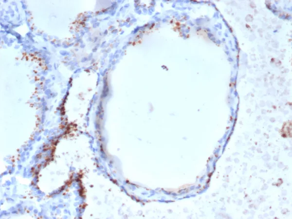 Formalin-fixed, paraffin-embedded human thyroid stained with GAD2 (GAD65) Mouse Monoclonal Antibody (GAD2/6484). HIER: Tris/EDTA, pH9.0, 45min. 2°C: HRP-polymer, 30min. DAB, 5min.