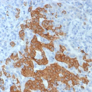 Formalin-fixed, paraffin-embedded human pancreas stained with GAD2 Recombinant Rabbit Monoclonal Antibody (GAD2/8394R). HIER: Tris/EDTA, pH9.0, 45min. 2°C: HRP-polymer, 30min. DAB, 5min.