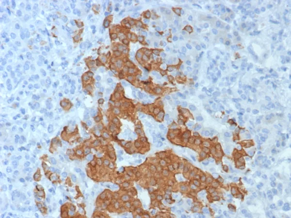 Formalin-fixed, paraffin-embedded human pancreas stained with GAD2 Recombinant Rabbit Monoclonal Antibody (GAD2/8394R). HIER: Tris/EDTA, pH9.0, 45min. 2°C: HRP-polymer, 30min. DAB, 5min.