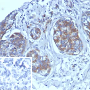 Formalin-fixed, paraffin-embedded human ovarian cancer stained with AMBP Mouse Monoclonal Antibody (AMBP/4533). Inset: PBS instead of primary antibody; secondary only negative control.