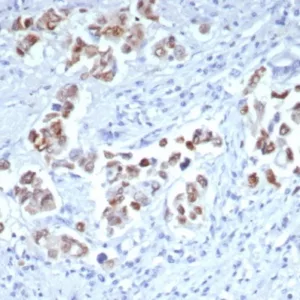 Formalin-fixed, paraffin-embedded human breast carcinoma stained with GATA-3 Recombinant Rabbit Monoclonal Antibody (GATA3/7685R). HIER: Tris/EDTA, pH9.0, 45min. 2°C: HRP-polymer, 30min. DAB, 5min
